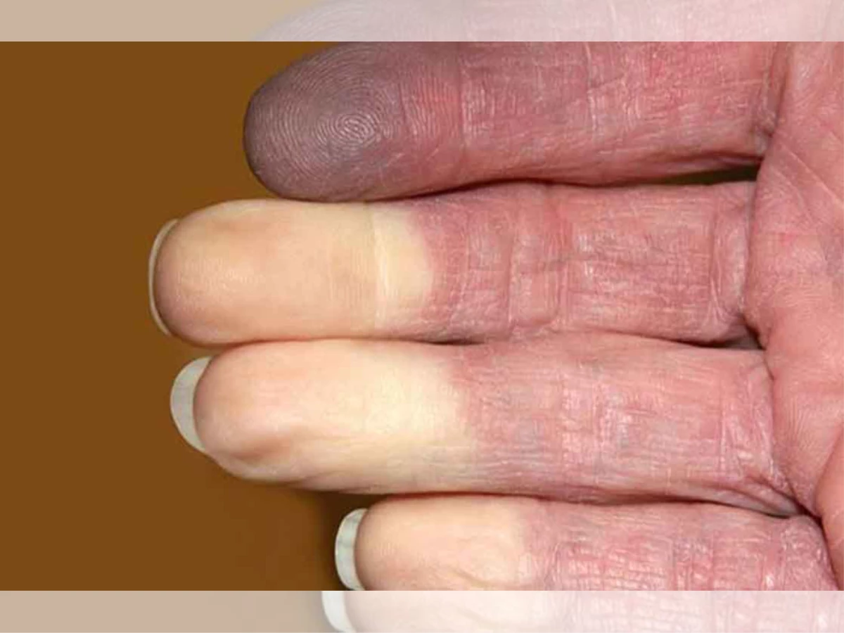 بیماری انگشت سفیدی
